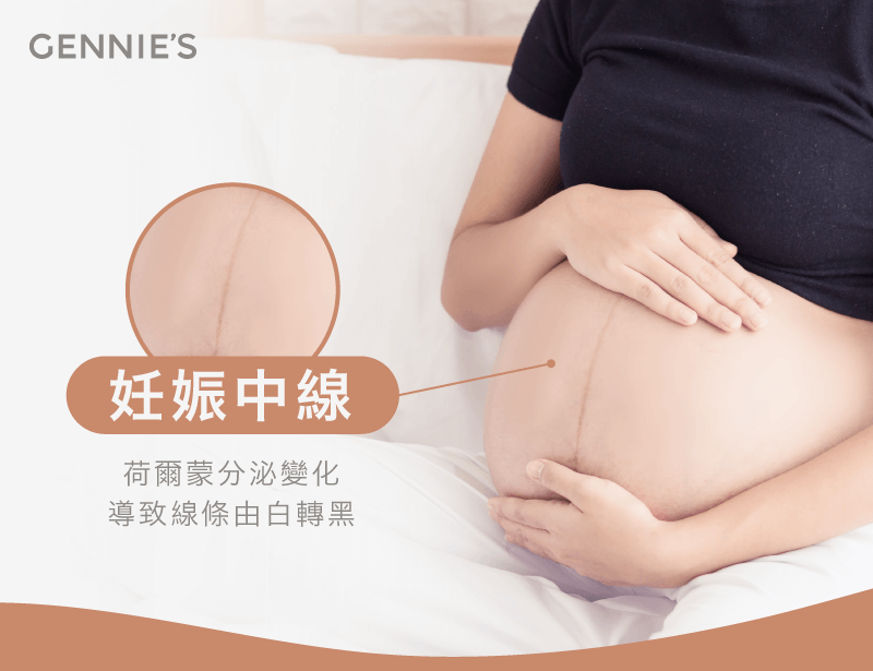 妊娠中線-懷孕肚子有線