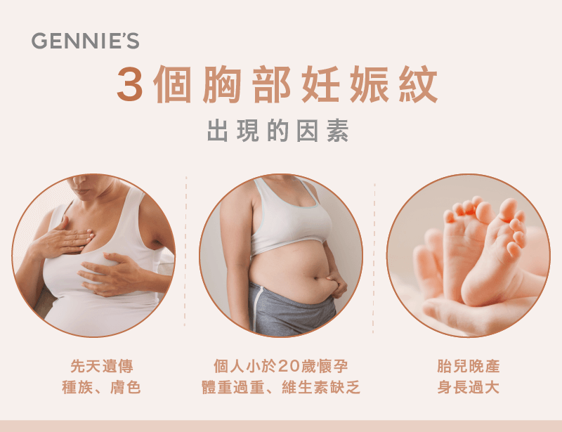 妊娠紋出現的3個原因-撫紋霜推薦