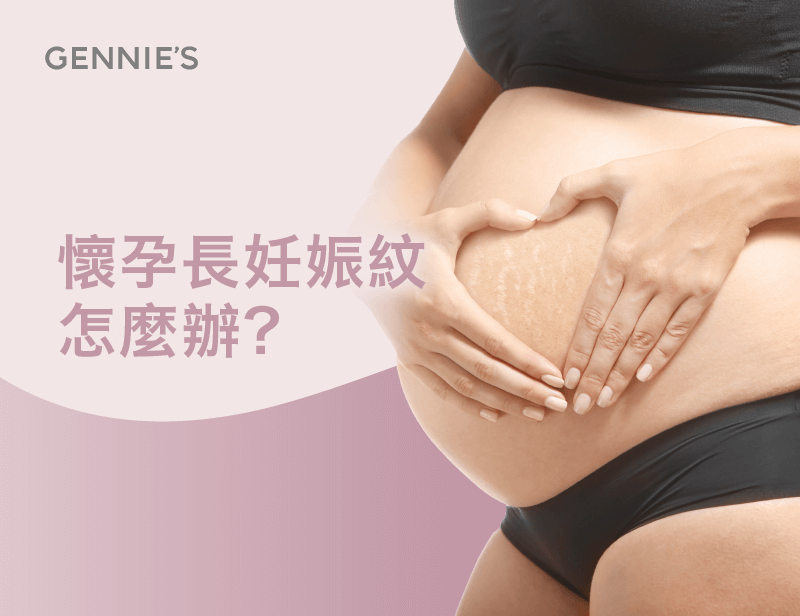 懷孕長妊娠紋-懷孕妊娠紋
