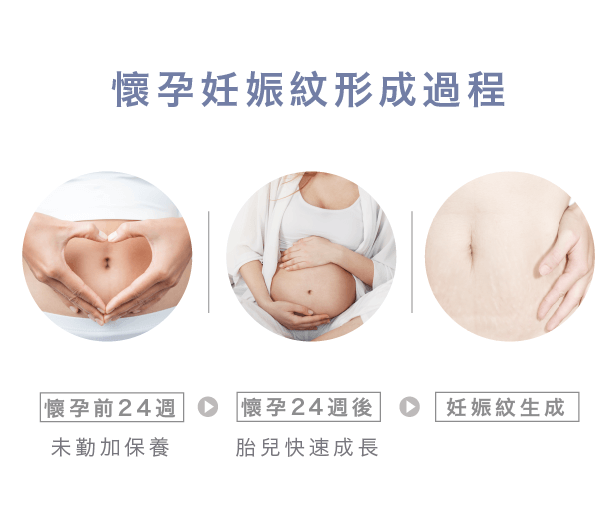 妊娠紋形成過程-孕期妊娠紋保養